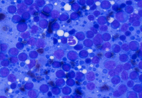 Lymphoma cytology analysis